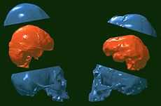 Comparaison du cerveau d'Homo floresiensis et d'un microcéphale