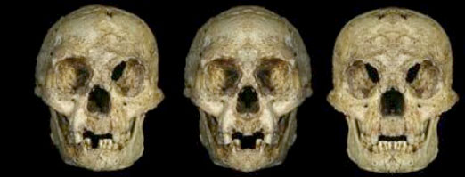 Crânes floresiensis trisomie 21