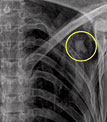 Epaule radiograph&eacute;e d'Otzi