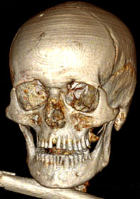 Reconstruction 3D du crâne d'Otzi