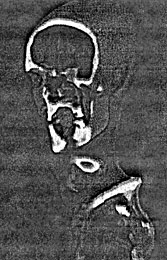 La pointe de fl&egrave;che fich&eacute;e dans l'&eacute;paule d'Otzi
