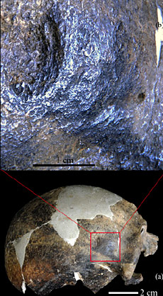 La fracture sur le crâne de l'homme de Maba (Chine) montrant des traces de violence à la préhistoire il y a 150 à 200 000 ans