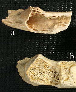 Tumeur cancereuse sur les os de néandertal il y a 120 000 ans...