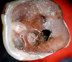 Dent perforée trouvée sur le site de Mehrgarh - Pakistan