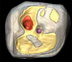 Reconstitution 3D d'une dent perforée au néolithique
