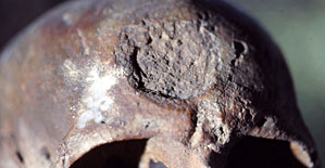 L&eacute;sion d'histiocytose x sur le front de Cro-Magnon