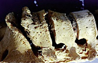 Traces de tuberculose sur des vert&egrave;bres