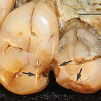 Dents présentant des morceaux cassés