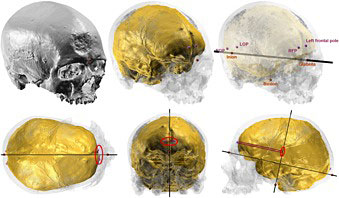 Mesure des crânes pour quantifier les "pétalias"
