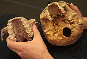 Dentition comparée de Paranthropus boisei et Homo sapiens