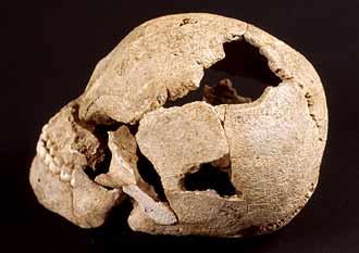 Crâne à double trépanation de Lingolsheim