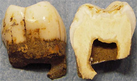 Analyse des dents d'un néandertalien de Payre