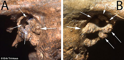 excroissance conduit auditif shanidar 1