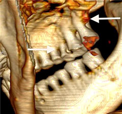 Ötzi chez le dentiste