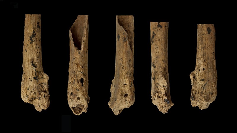 Une amputation au Paléolithique il y a 31 000 ans