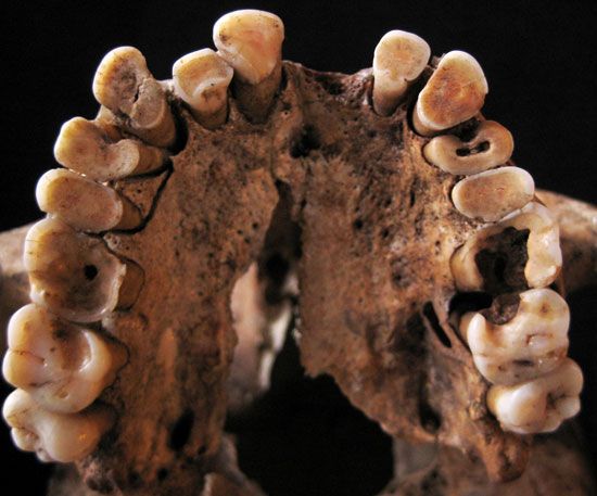 Des caries dentaires avant l’apparition de l’agriculture